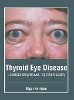 Thyroid Eye Disease: Understanding Graves' Ophthalmopathy H 250 p. 23