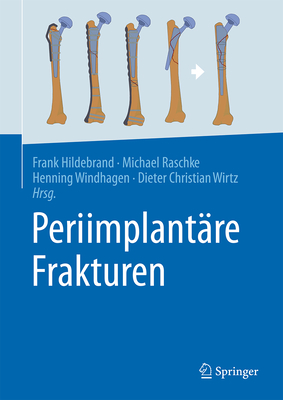 Periimplantäre Frakturen 2025th ed. H 220 p. 24