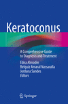 Keratoconus:A Comprehensive Guide to Diagnosis and Treatment '23